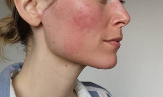 تقشير البشرة