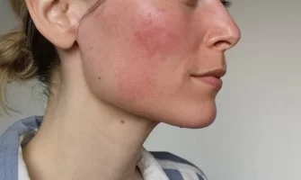 تقشير البشرة